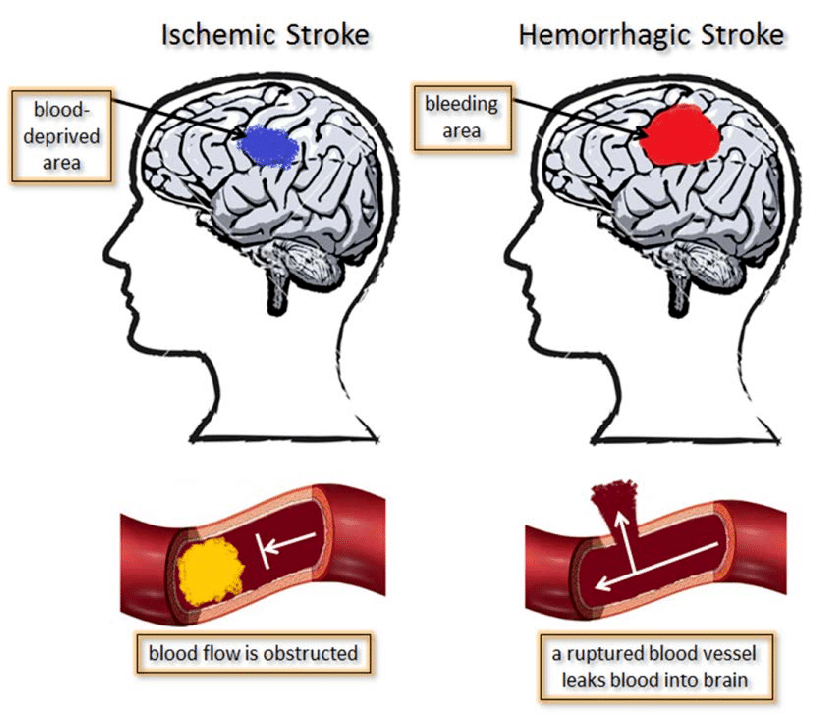 Medical Management of Acute Strokes